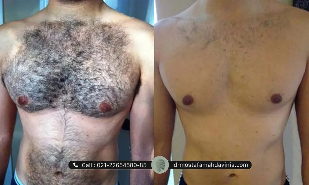 تصویر قبل و بعد لیزر موهای زائد بدن مراجعه کننده مرد - از کجا بفهمیم لیزر اثر کرده؟
