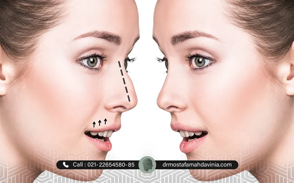 فرم دادن به بینی بدون جراحی