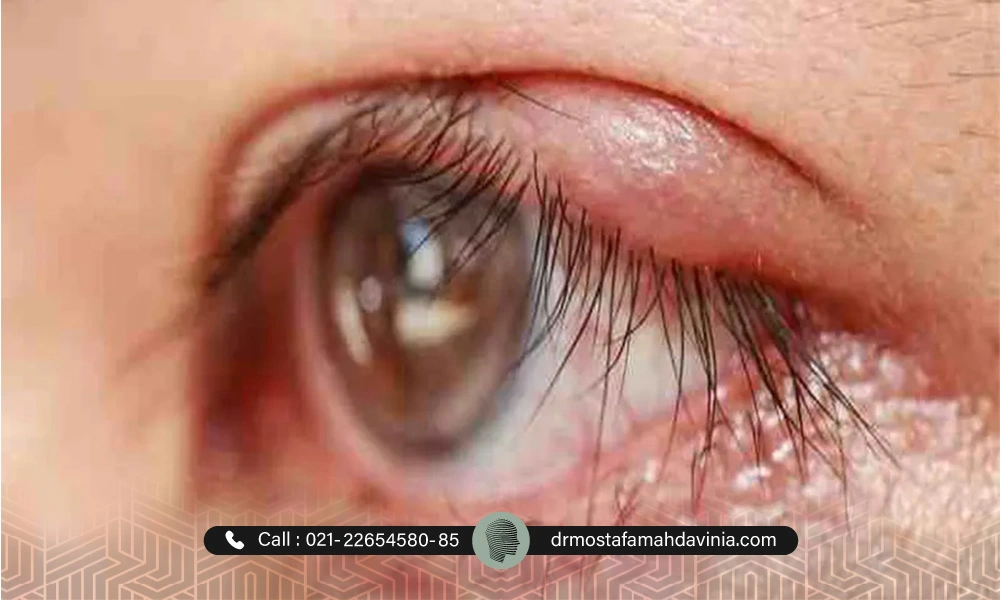 عوارض و التهاب بعد از لیفت چشم با نخ