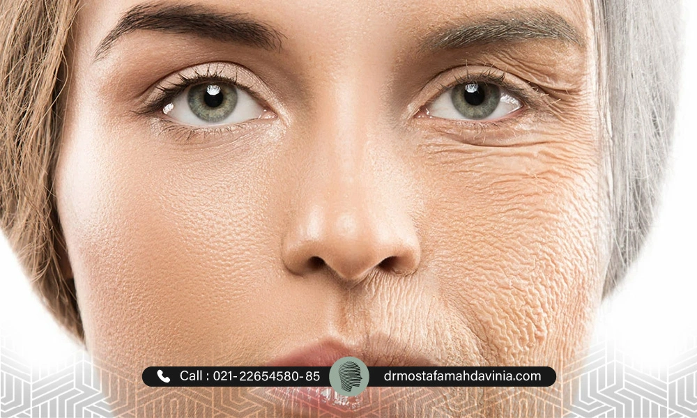 تاثیر چین و چروک بر پوست صورت قبل و بعد از ایجاد چروک ها - چین و چروک صورت