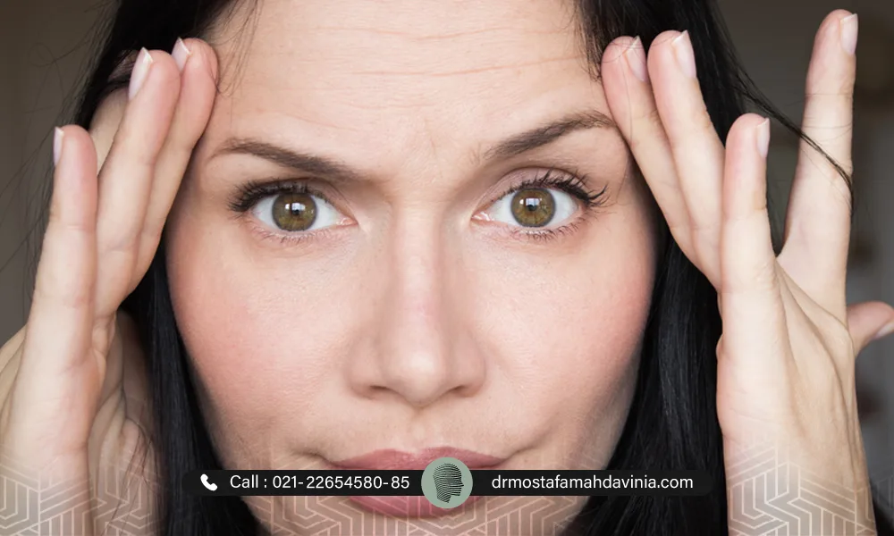 ماندگاری لیفت شقیقه با نخ