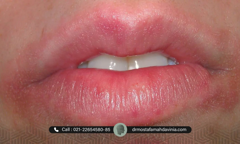 نکروز لب بعد از تزریق ژل