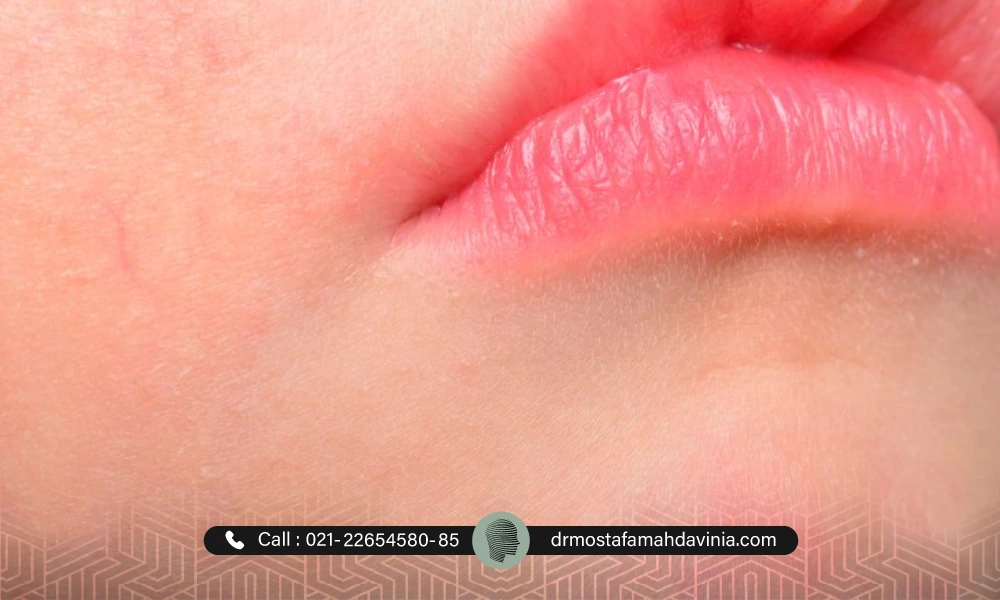نکروز شدن لب ها بعد از تزریق ژل به لب های یک خانم
