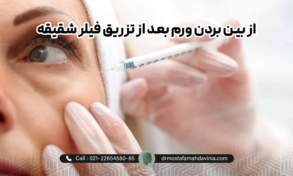 تزریق ژل شقیقه برای خانمی سن بالا که در نگاه کردن به سمت راست خود است. | ورم بعد از تزریق ژل شقیقه