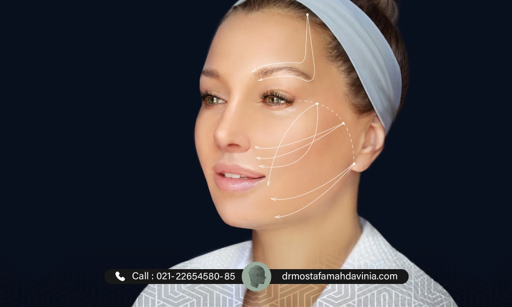 انجام خط کشی های قبل از انجام لیفت صورت | پاره شدن نخ لیفت صورت