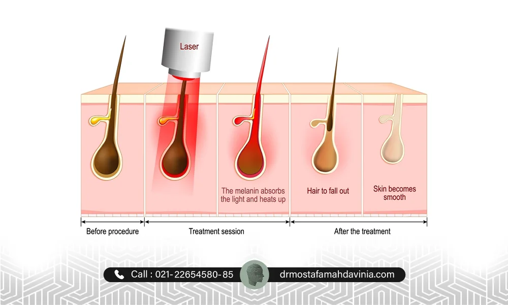 لیزر موهای زائد بیکینی