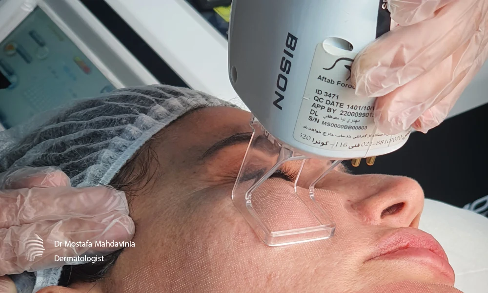 دکتر مهدوی نیا در حال انجام لیزر co2 فرکشنال بر روی صورت یک خانم