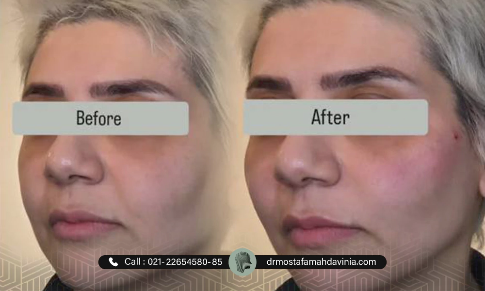 نمونه کار لیفت صورت با نخ