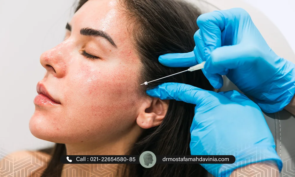 صورت خانمی که لیفت نخ با نخ PDO داشته است