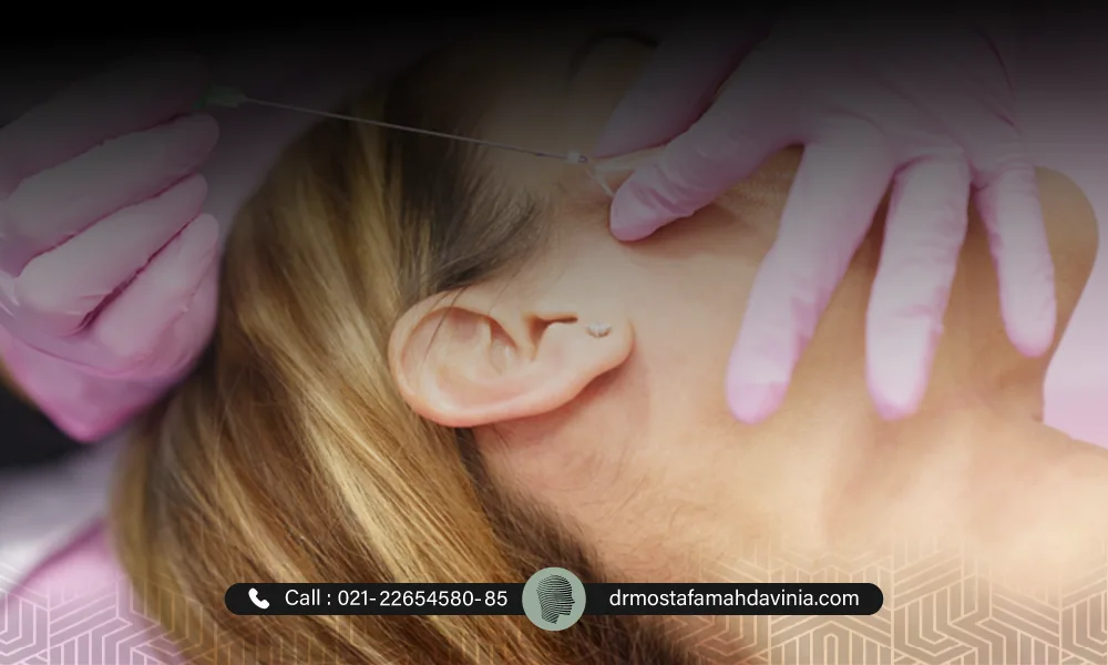 لیفت صورت با نخ چگونه است؟