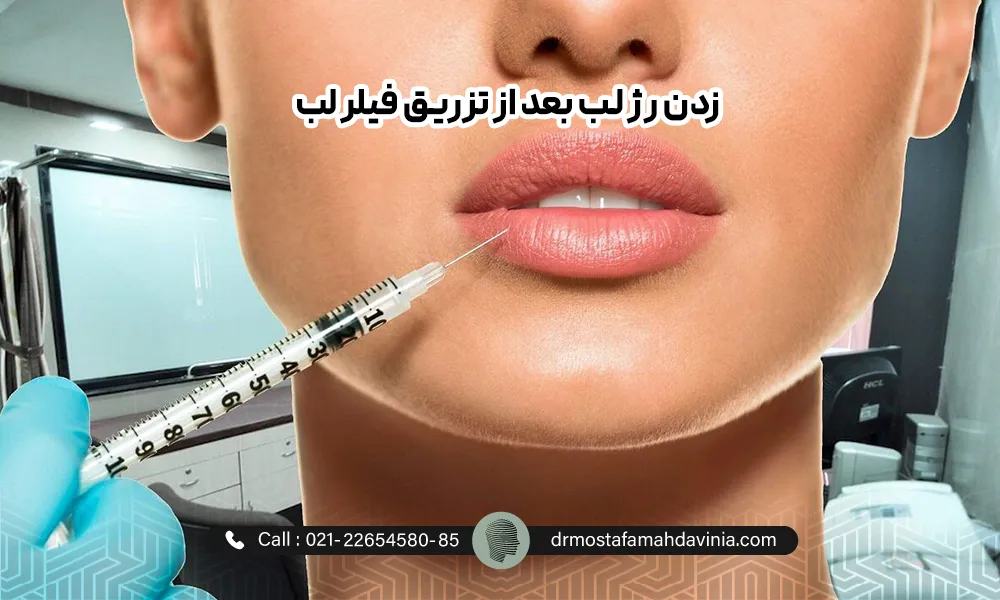 تزریق فیلر به لب پایین یک خانم | آرایش کردن بعد از تزریق ژل