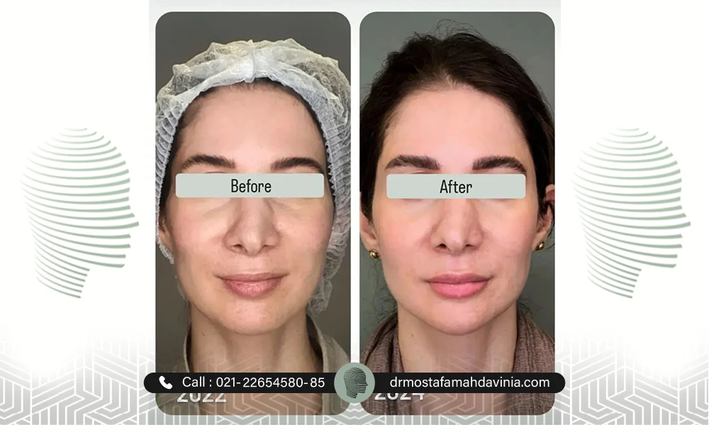 عکس تزریق نیم سی سی ژل لب 