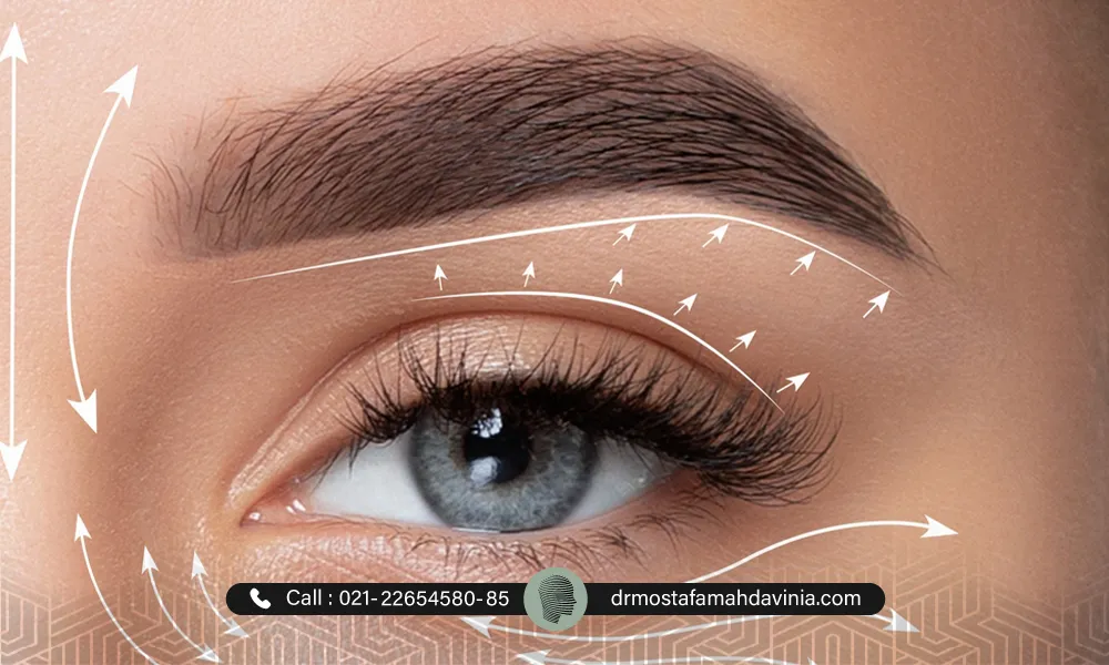 تاثیرات بوتاکس چشم گربه ای بر روی چشم یک خانم