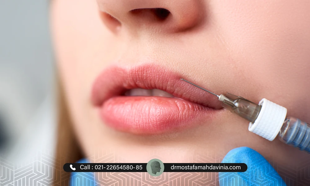 تزریق فیلر لب نچرال