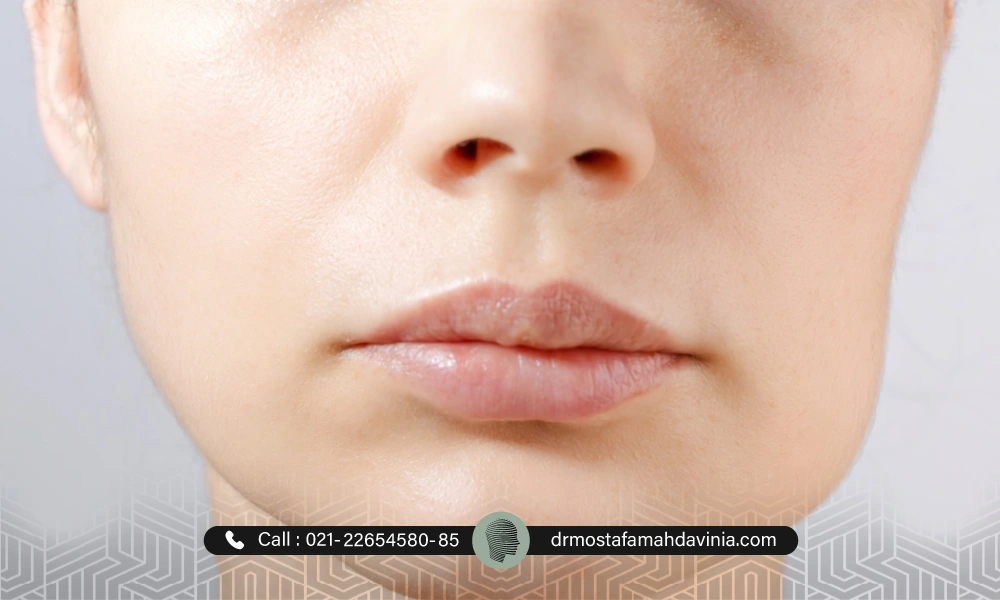 ورم ایجاد شده بر روی صورت فرد متقاضی بعد از انجام لیفت نخ | درمان ورم صورت بعد از لیفت با نخ