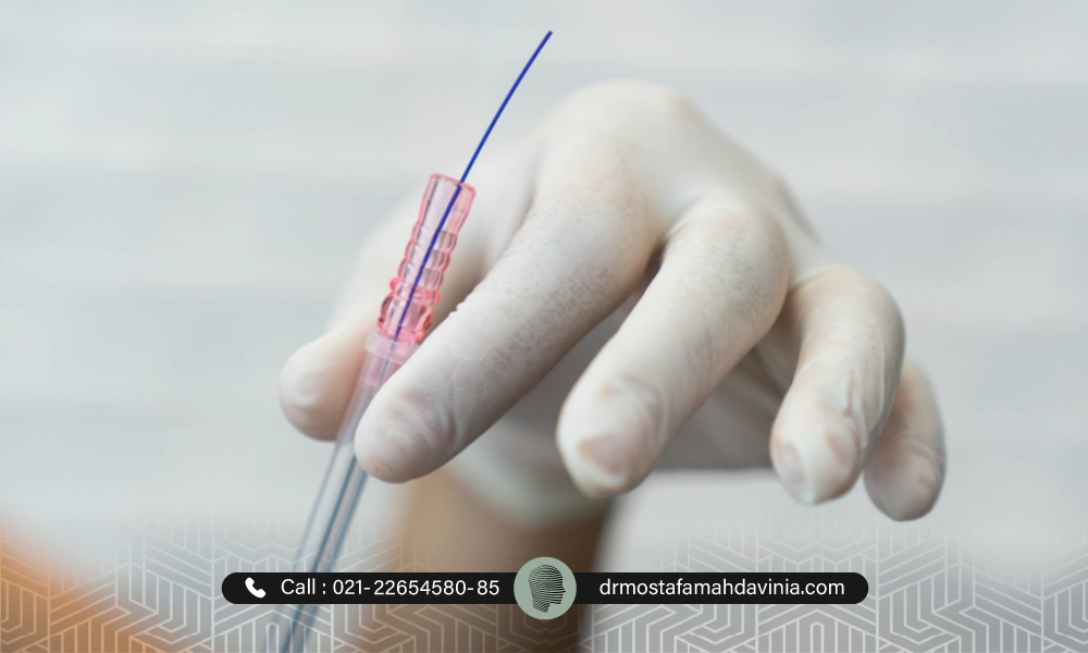 نوعی از نخ های لیفت | مدت زمان جذب نخ لیفت