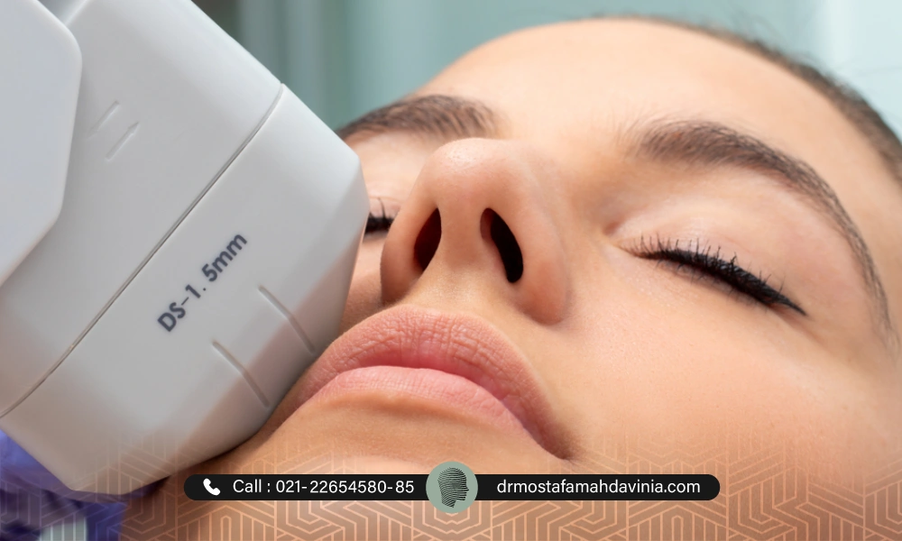 انجام هایفوتراپی صورت توسط یک خانم |اندولیفت بهتر است یا هایفو؟