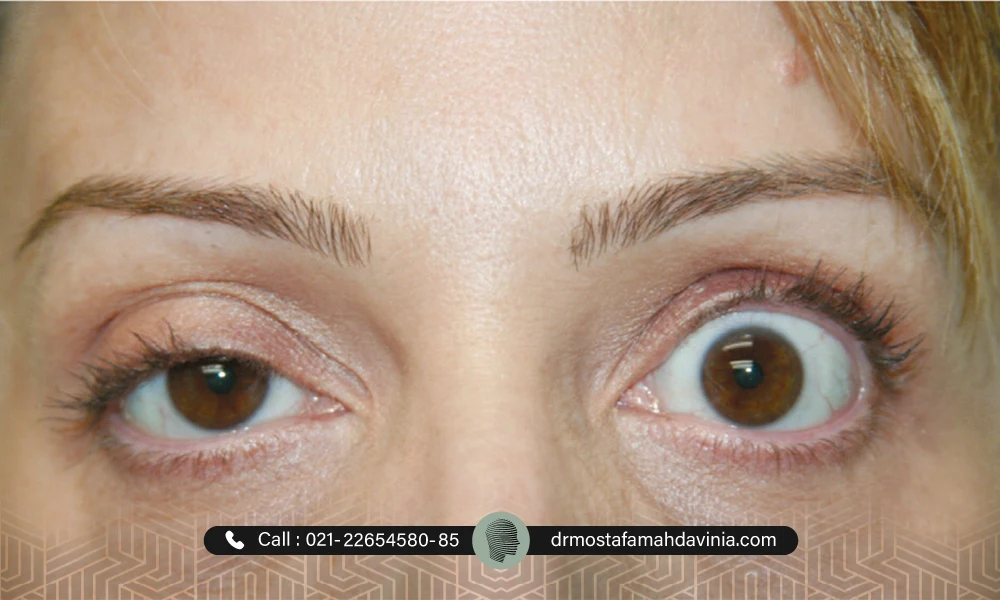 افتادگی پلک بعد از تزریق بوتاکس | عوارض بوتاکس بعد از چند سال