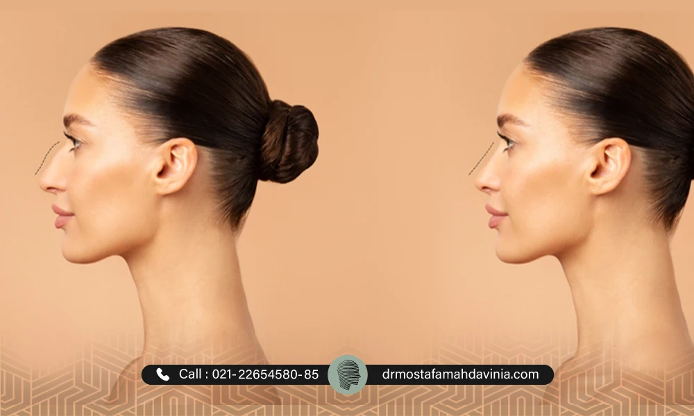 کوچک کردن بینی بدون جراحی