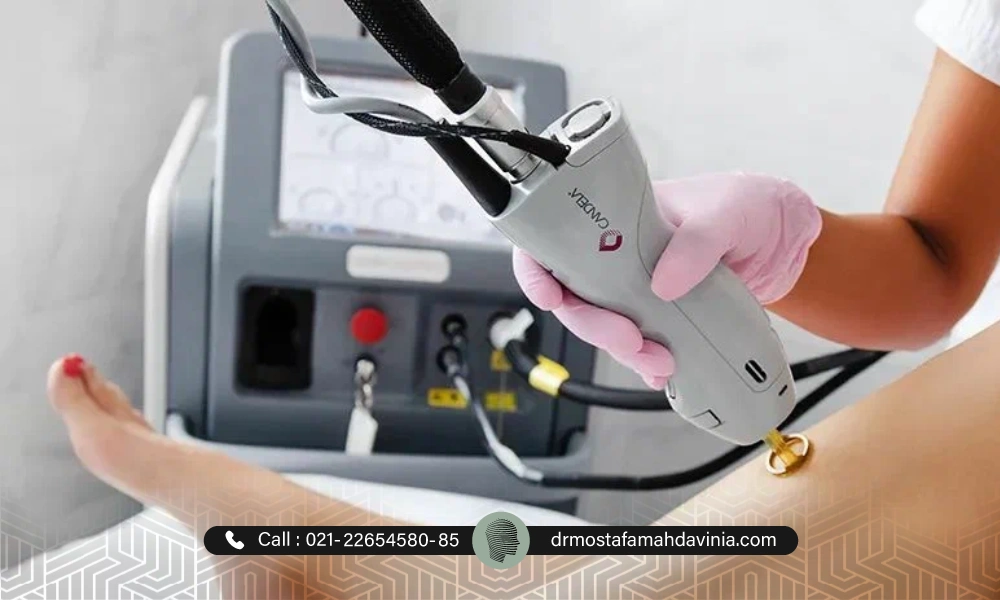 رعایت فاصله جلسات لیزر پا با دستگاه کندلا از طرف یک خانم