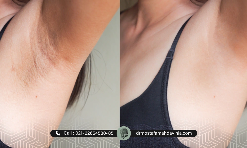 عکس قبل و بعد رفع تیرگی زیر بغل با روش خانگی