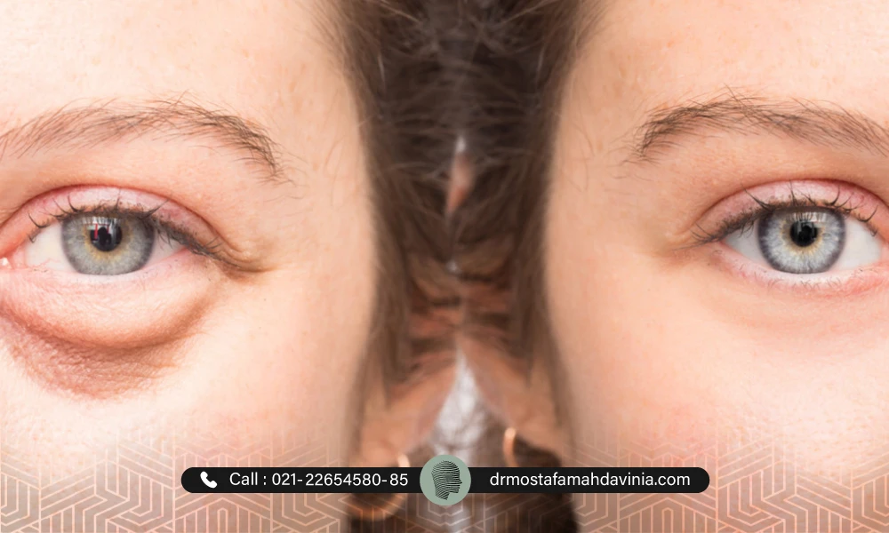 تصویر قبل و بعد ورم زیر چشم بعد از فیلر یک خانم