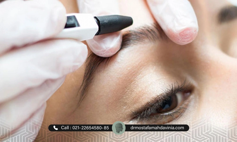 الکترولیز پیشانی برای از بین بردن موهای زائد