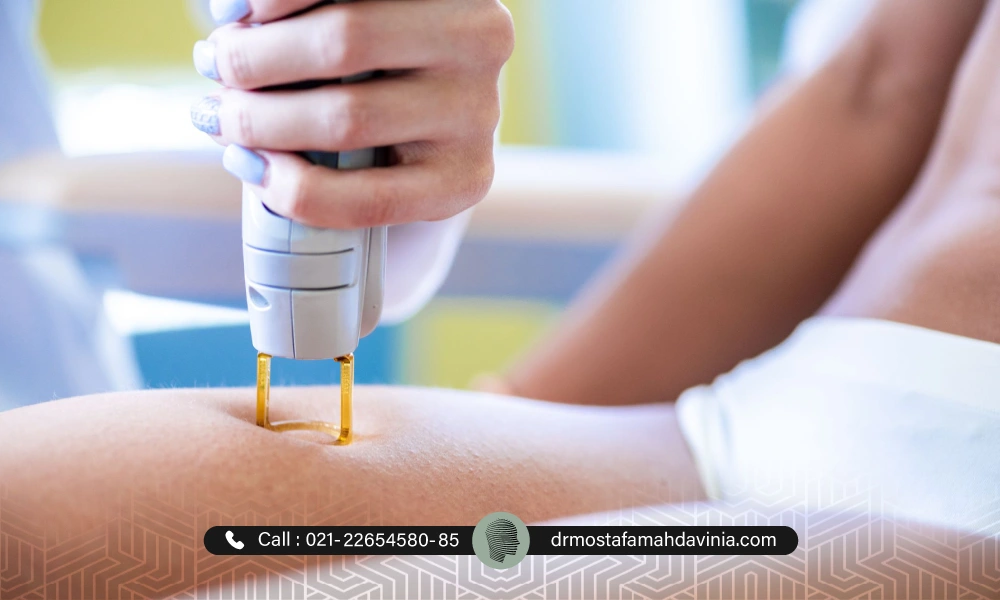 از بین بردن موهای زائد ران پا توسط اپراطور لیزر برای یک خانم | فاصله بین جلسات لیزر