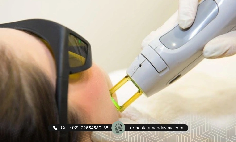 انجام لیزر موهای زائد برای صورت یک خانم توسط دستگاه الکساندرایت | فاصله بین جلسات لیزر