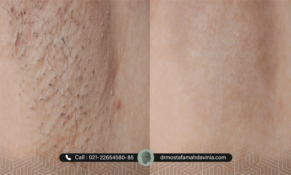 تصویر قبل و بعد رفع تیرگی زیر بغل با لیزر 