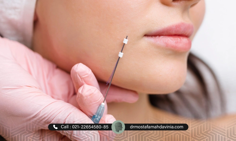 انجام لیفت با نخ برای یک خانم توسط پزشکی با دستکش های صورتی | دوره نقاهت لیفت با نخ