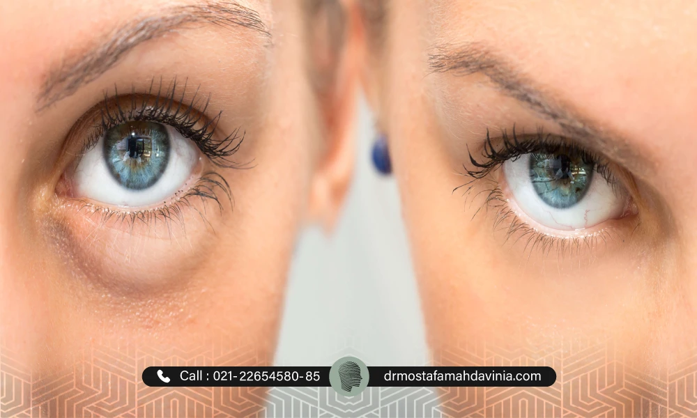 خانمی با چشم های رنگی که ورم زیر چشم بعد از فیلر را پشت سر گذاشته است.