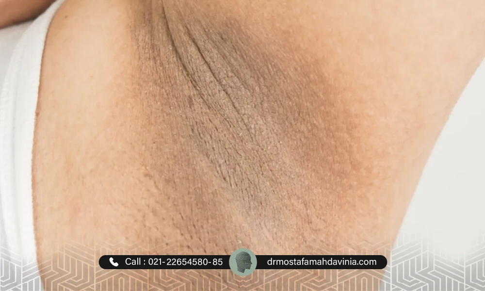 عکس زیر بغل تیره | رفع تیرگی زیر بغل