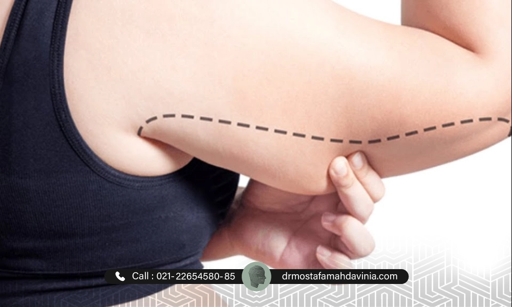 بازوی بزرگ و افتاده یک خانم که نیاز به لیفت بازو با نخ دارد.