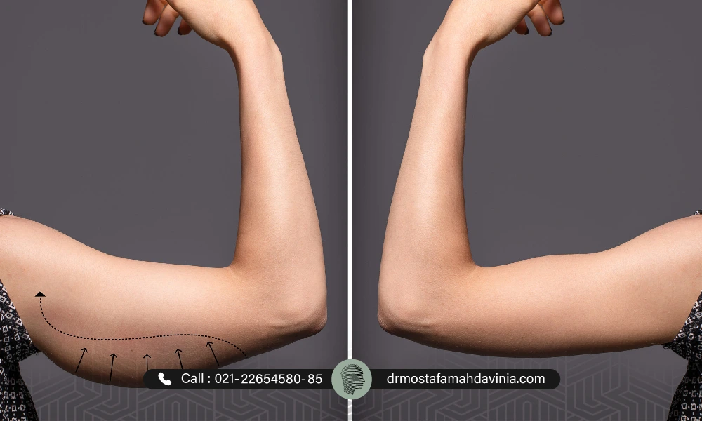 عکس قبل و بعد لیفت بازو با نخ