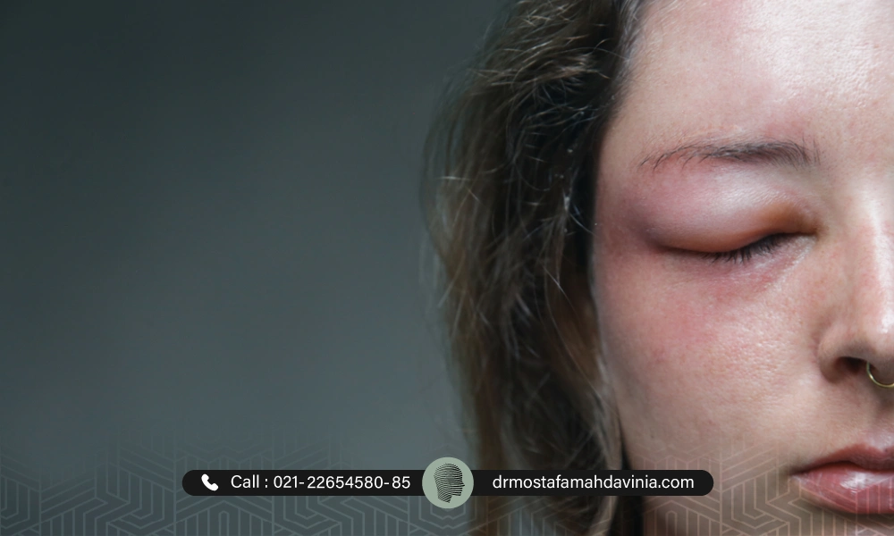 ورم صورت بعد از تزریق ژل در یک خانم | ورم بعد از تزریق ژل