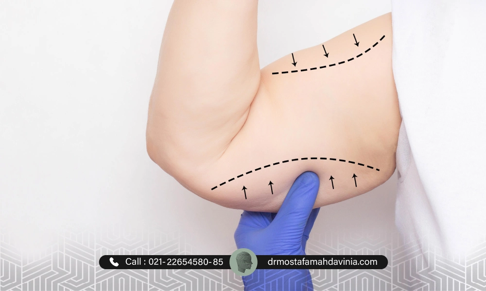 مشخص کردن مناطق لیفت بازو با نخ برای یک خانم.