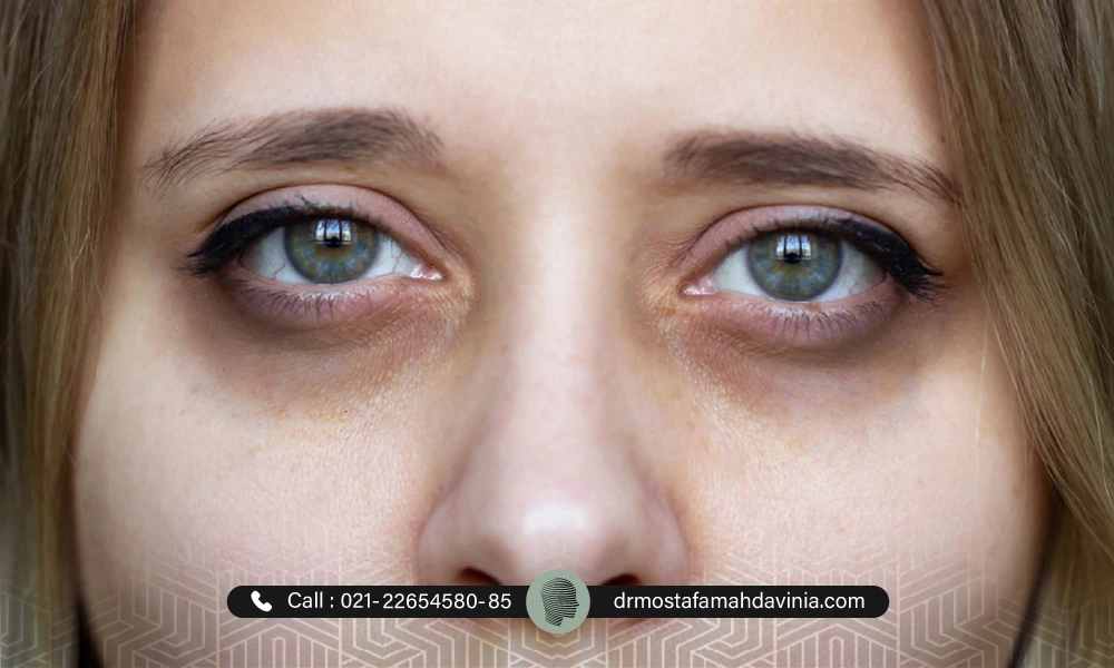 خانمی که گودی و سیاهی زیر چشم دارد و چهره اش خسته و پیرتر به نظر می رشد.