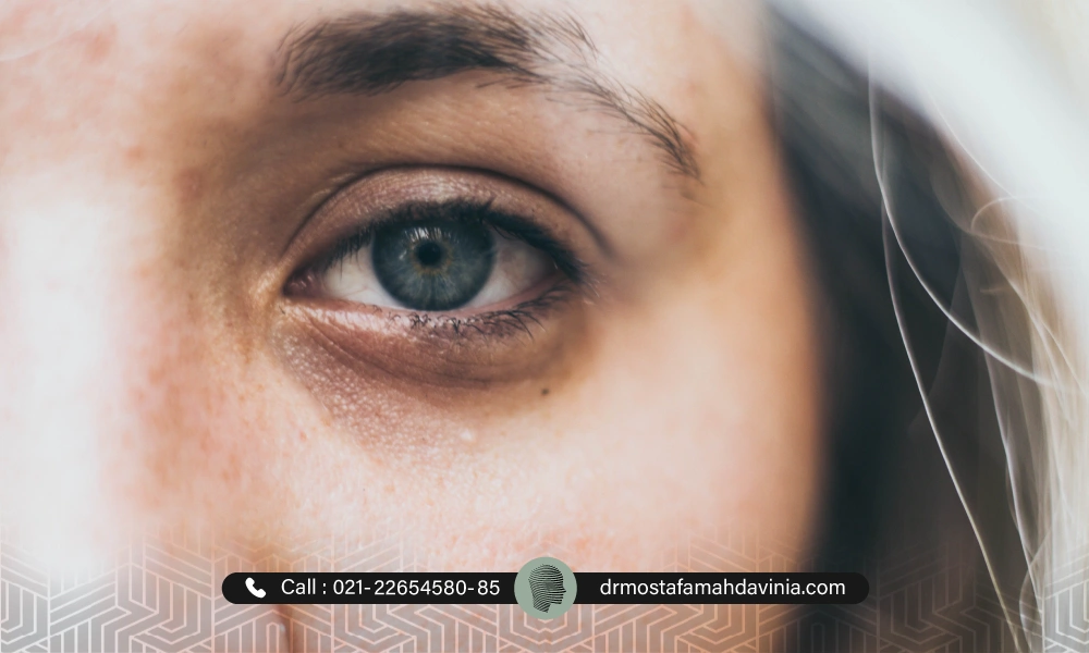 گودی زیر چشم خانم که باعث پیرتر به نظر آمدم خانم شده