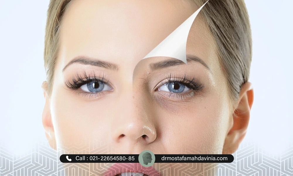 عکس قبل و بعد تزریق فیلر چشم