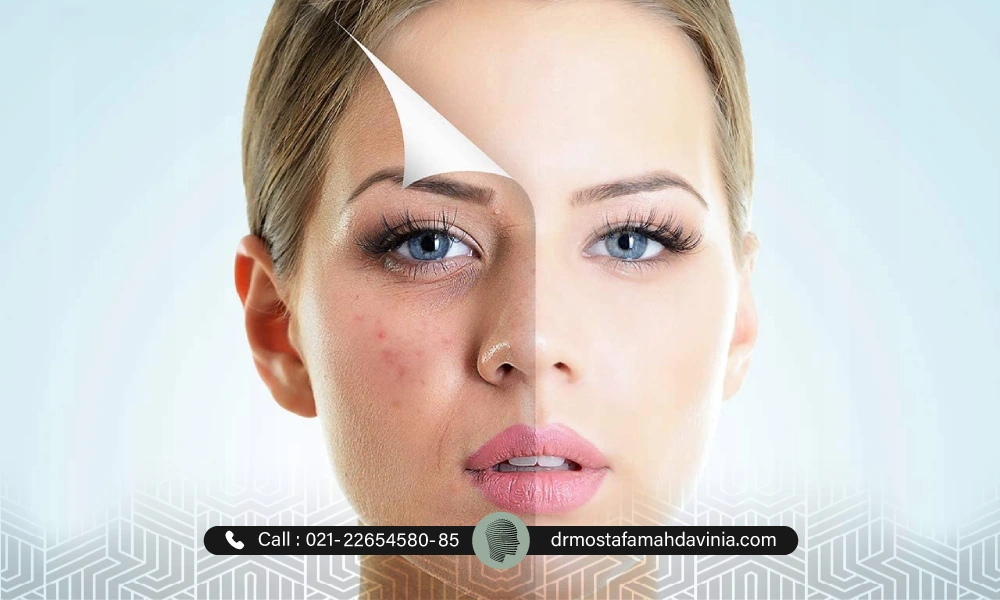 قبل از تزریق فیلر چشم و بعد از تزریق