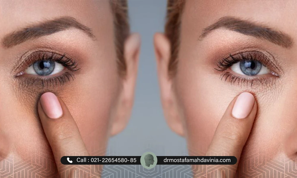 قبل و بعد گودی و تیرگی زیر چشم یک خانم که با انگشت نمایش می دهد.