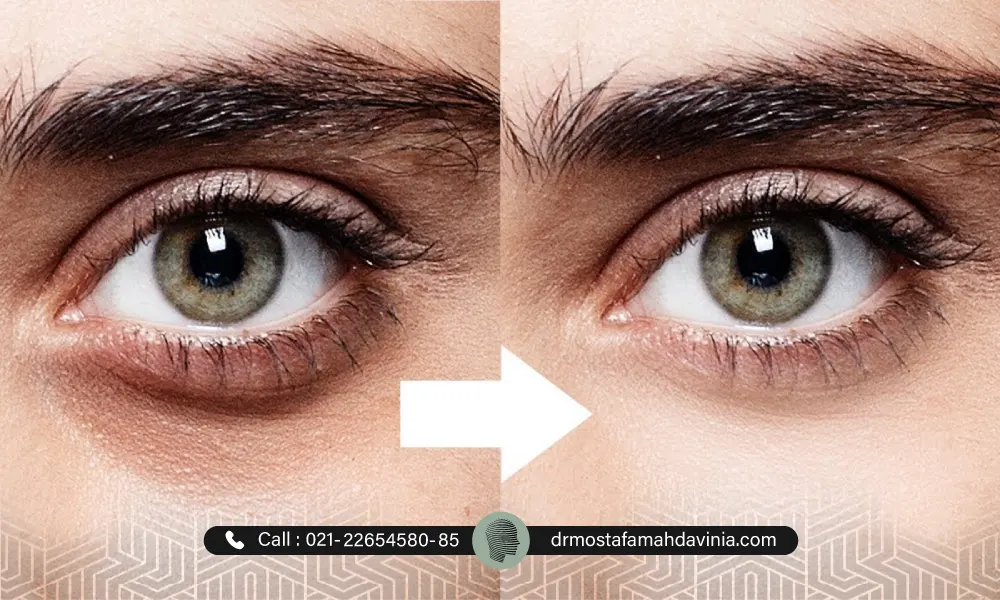 عکس قبل و بعد گودی زیر چشم یک خانم