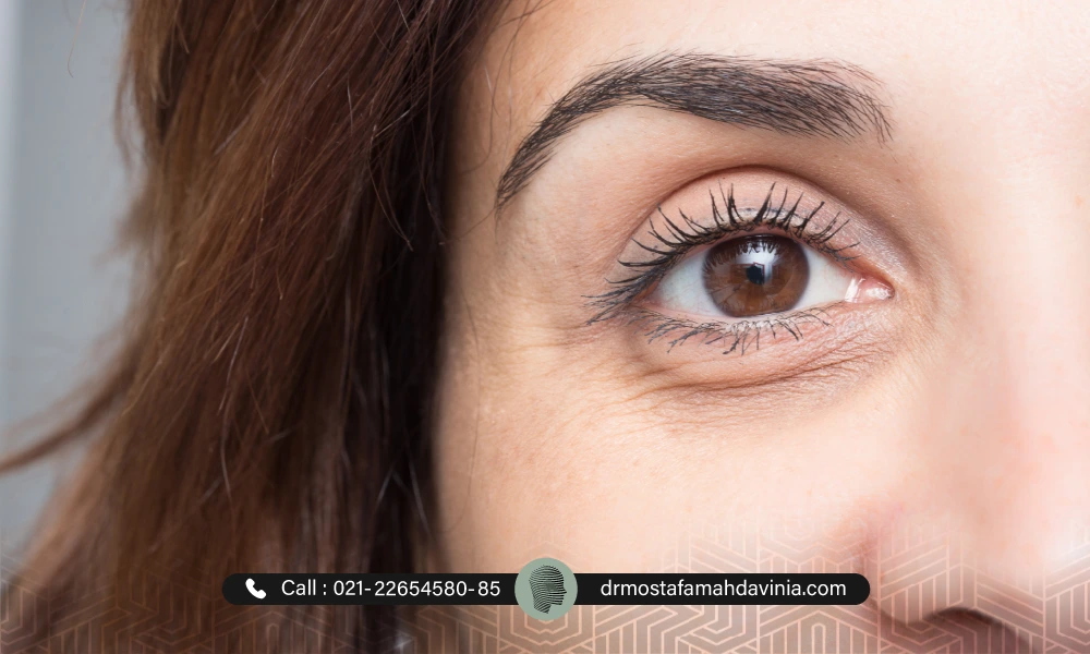 خانمی با موهای قهوه ای که گودی چشم دارد