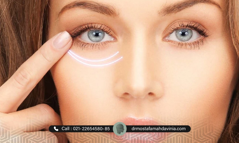 چین و چروک های اطراف چشم