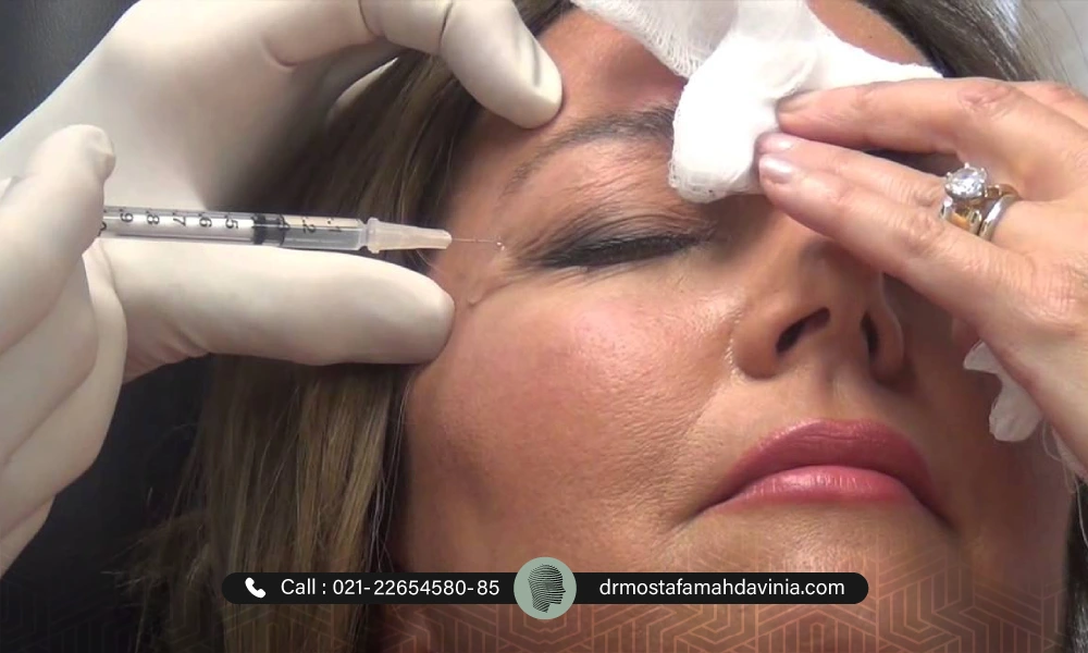 تزریق بوتاکس چشم توسط بهترین دکتر تزریق بوتاکس