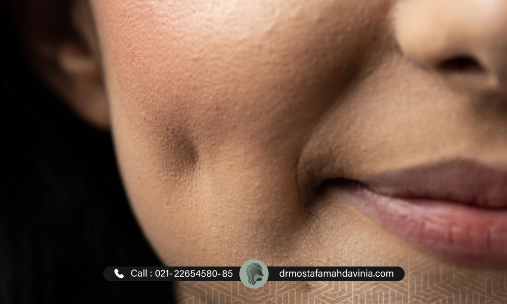 چال گونه ایجاد شده با نخ در گونه های یک خانم | چال گونه با نخ