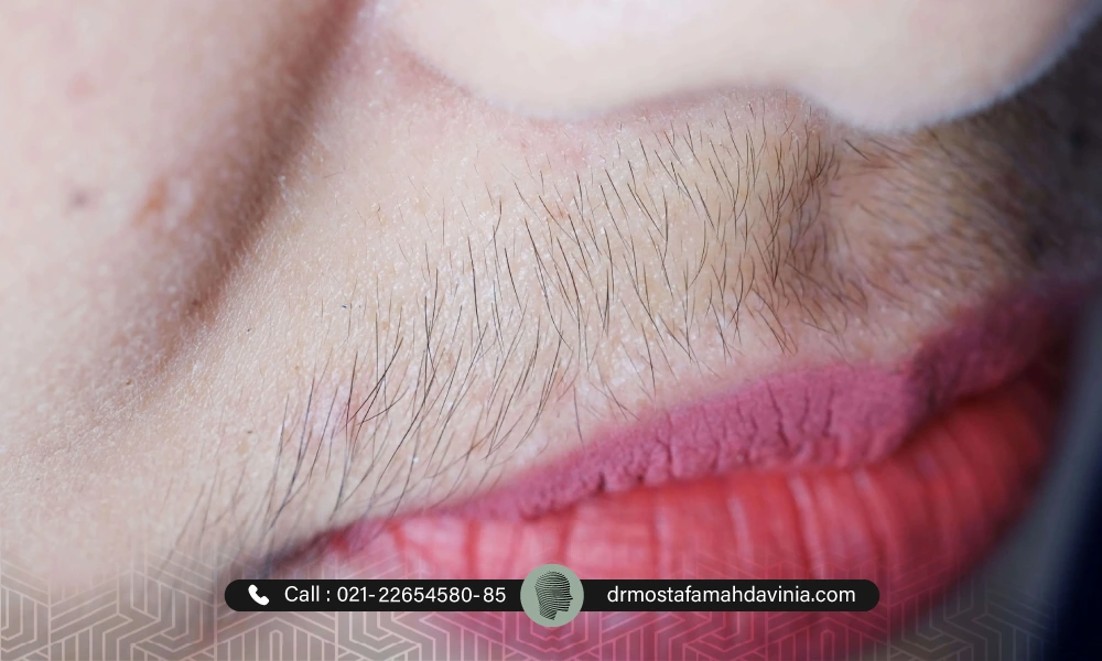 موهای زائد بالای لب های خانم | از بین بردن موهای زائد برای همیشه