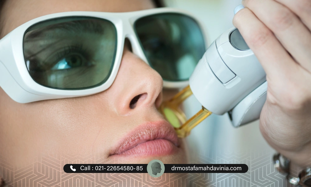لیزر صورت بالای لب برای از بین بردن موهای زائد صورت