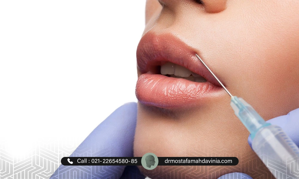 تزریق فیلر لب به لب بالایی یک خانم | از بین بردن ژل لب